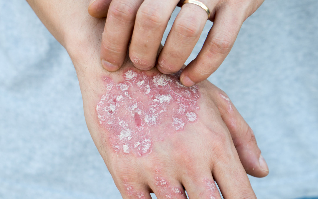 Psoriazisul și rolul dietei antiinflamatorii
