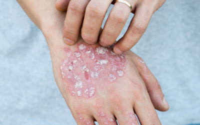 Psoriazisul și rolul dietei antiinflamatorii